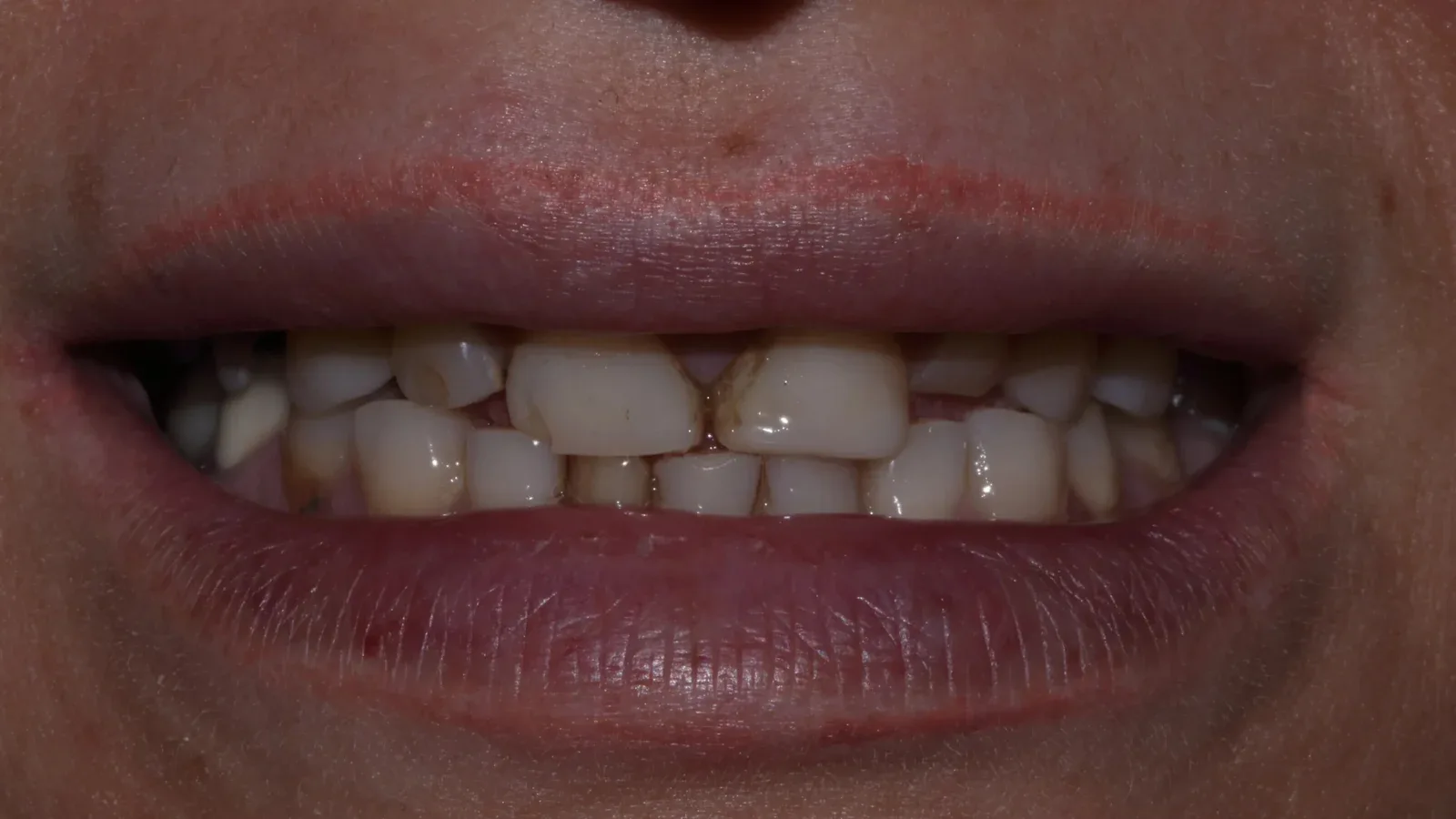 Full Zirconia Dental Restoration with Custom Smile Design and Bite Raise
