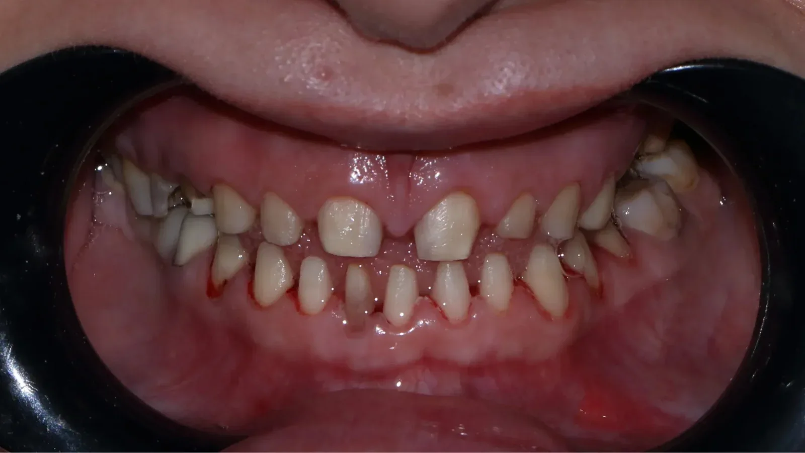 Full Zirconia Dental Restoration with Custom Smile Design and Bite Raise