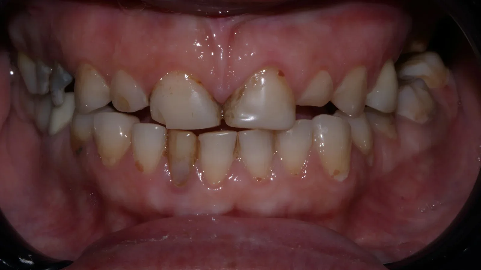 Full Zirconia Dental Restoration with Custom Smile Design and Bite Raise