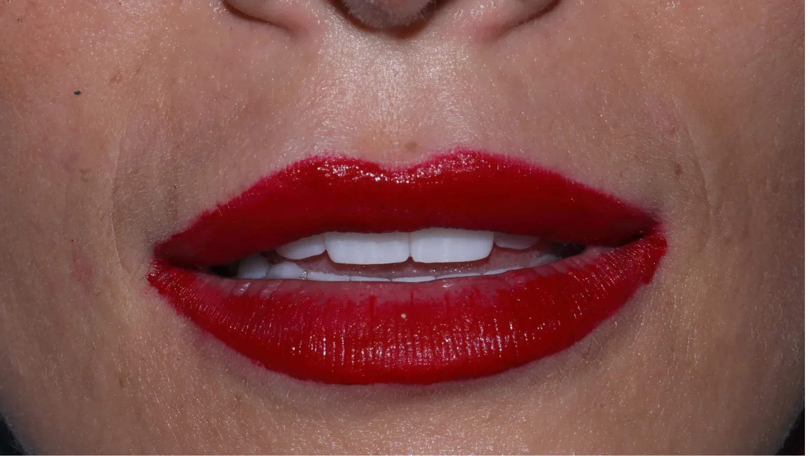 Full Zirconia Dental Restoration with Custom Smile Design and Bite Raise