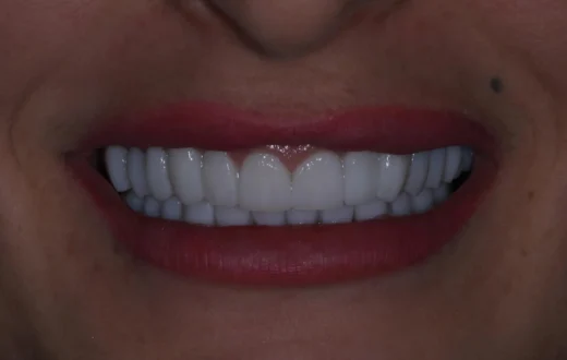 Dental case image: Upper and Lower Jaw Zirconia Restoration