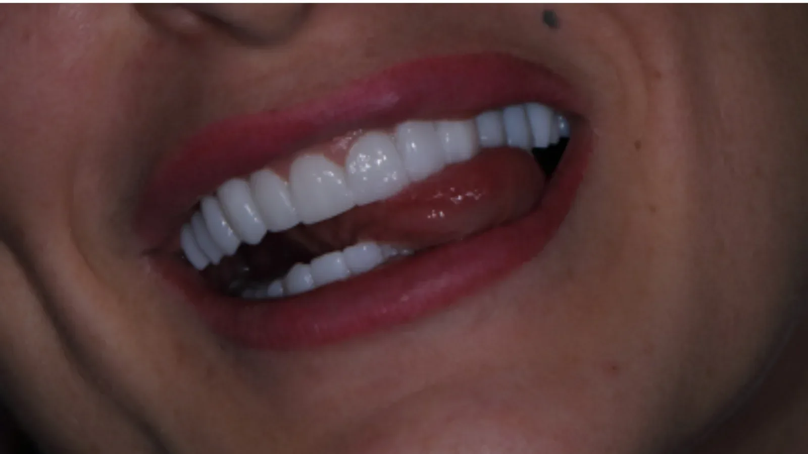 Upper and Lower Jaw Zirconia Restoration