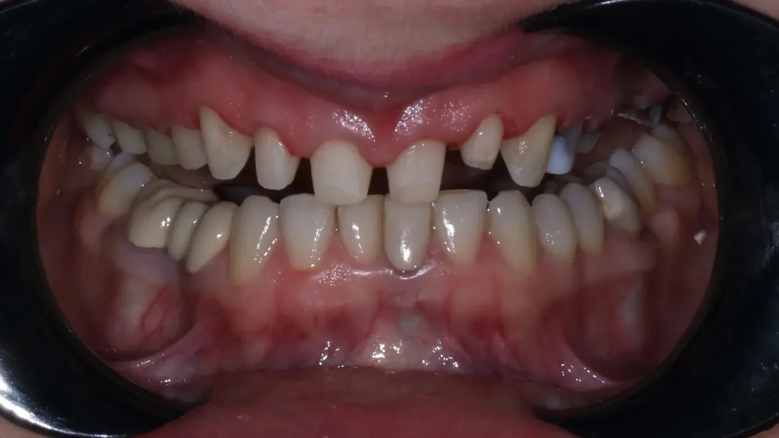 Upper and Lower Jaw Zirconia Restoration