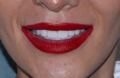 Full Zirconia Dental Restoration