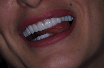 Full zirconia teeth restoration for the upper and lower jaw