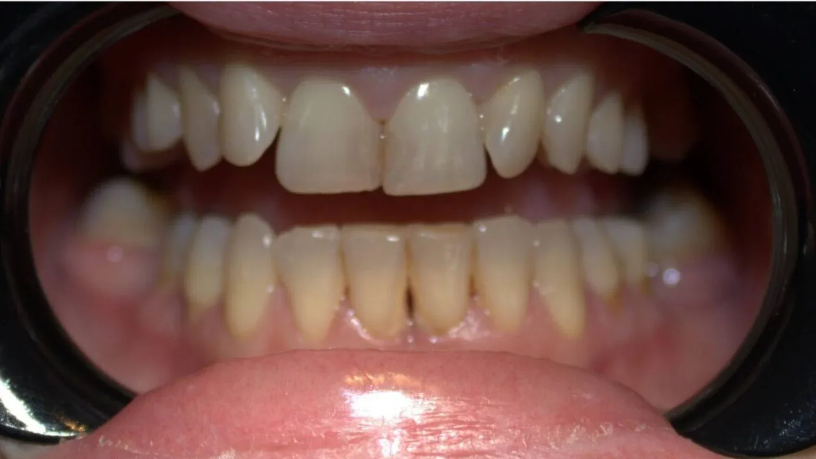 Zirconia Restoration for a Young Female Patient