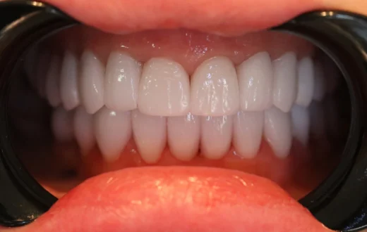 Dental case image: Zirconia Restoration for a Young Female Patient