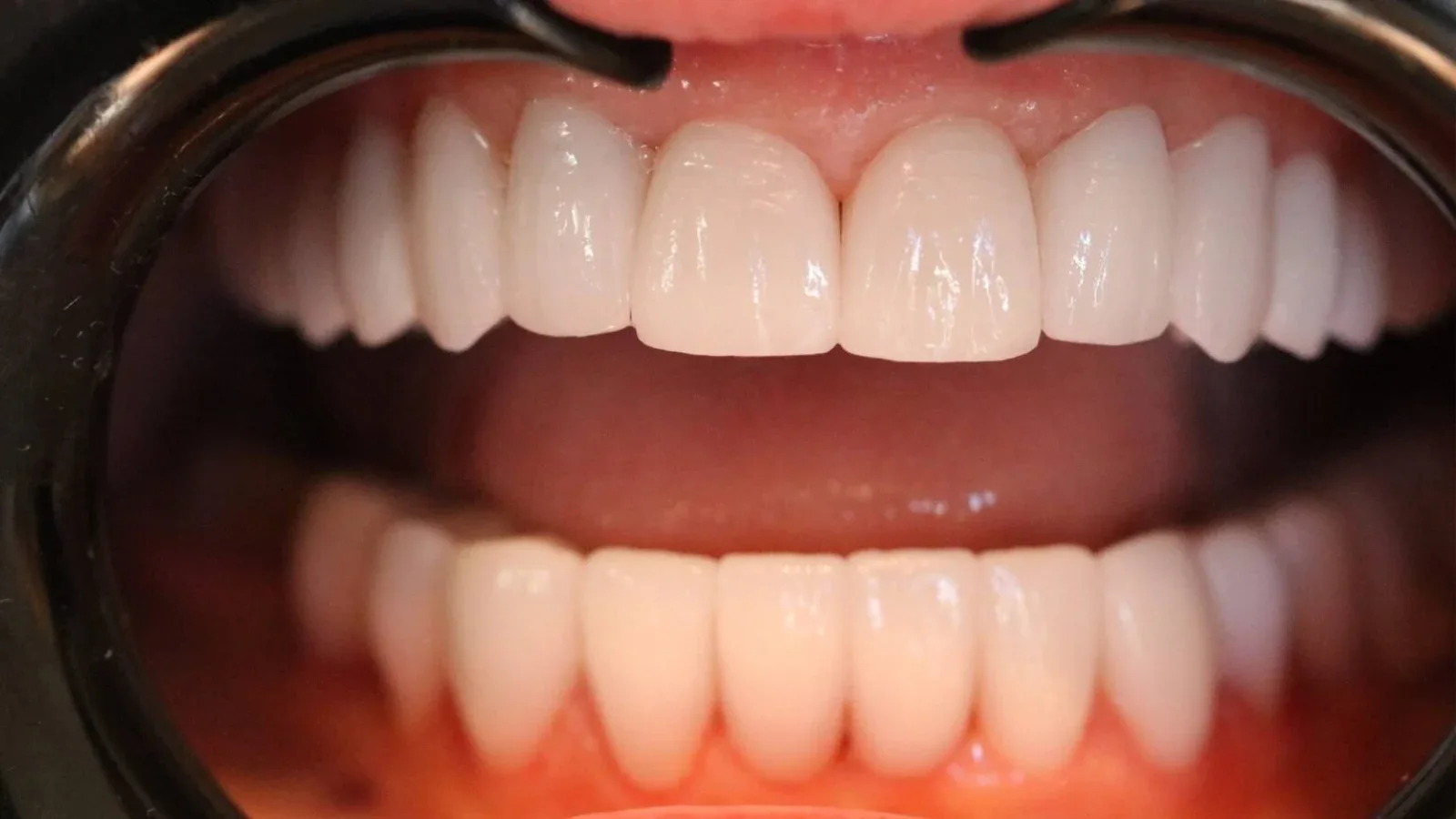 Zirconia Restoration for a Young Female Patient